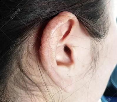 增大手術 耳洞 脫皮